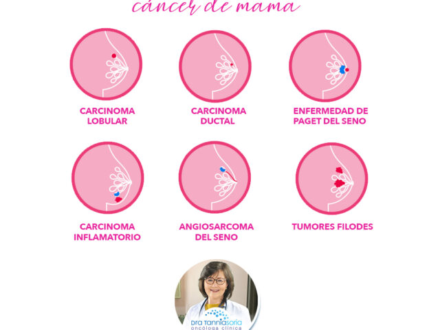 Tipos de cáncer de mama y sus síntomas