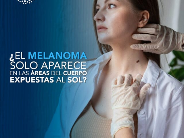 ¿El melanoma solo aparece en las áreas del cuerpo expuestas al sol?